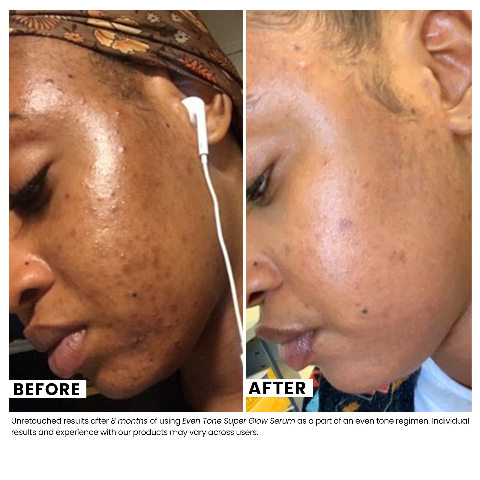 Woman's skin before and after using USRx Even Tone Super Glow Serum with visibly improved skin