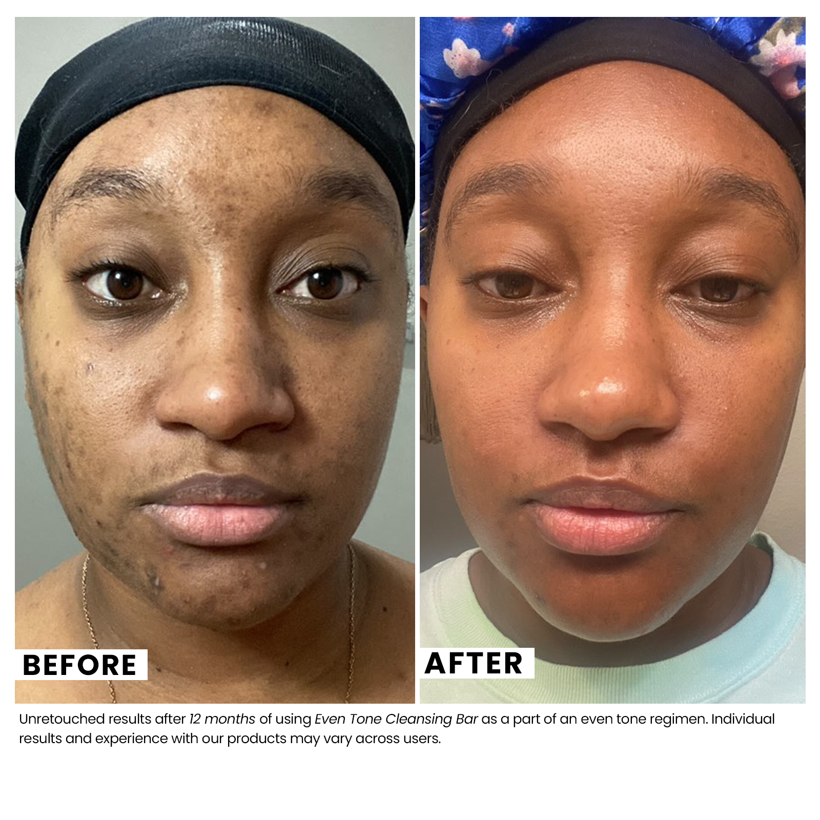 Woman's skin before and after using USRx Even Tone Cleansing Bar with visibly improved skin