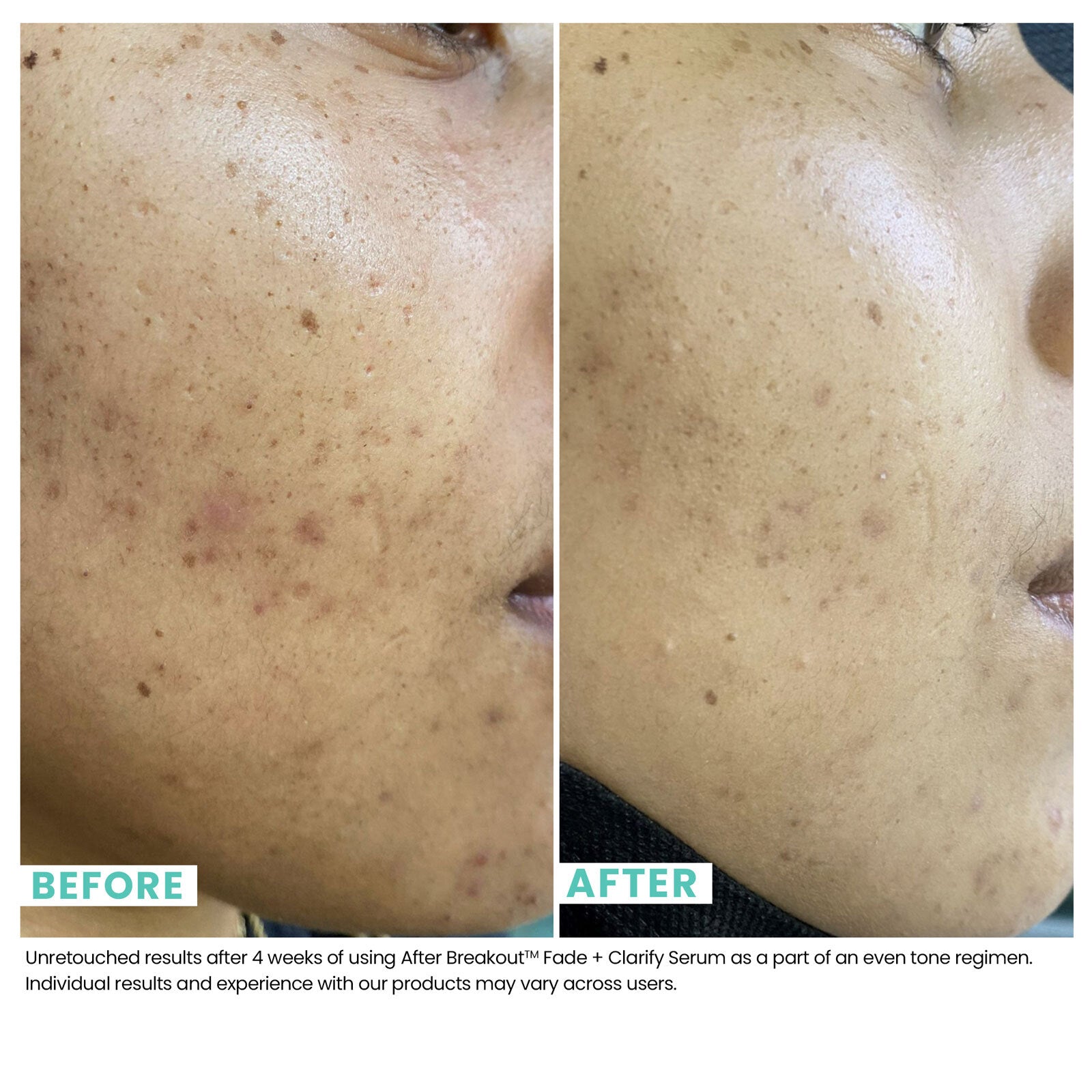 Comparison of skin before woman uses Urban Skin RX After Breakout Treatment Fade & Clarify Serum and after using it, with visibly clearer skin