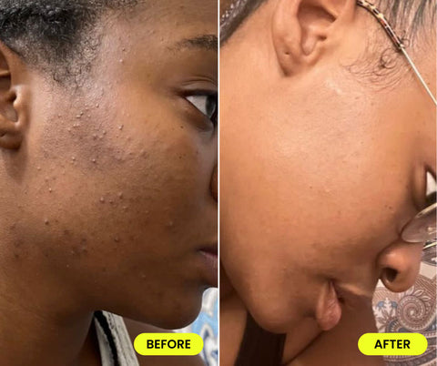 Comparison of woman's skin before and after using USRx Retinol Rapid Repair