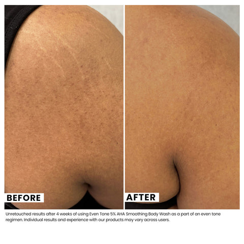 Woman's skin before and after using USRx Even Tone 5% AHA Smoothing Body Wash with visibly improved skin