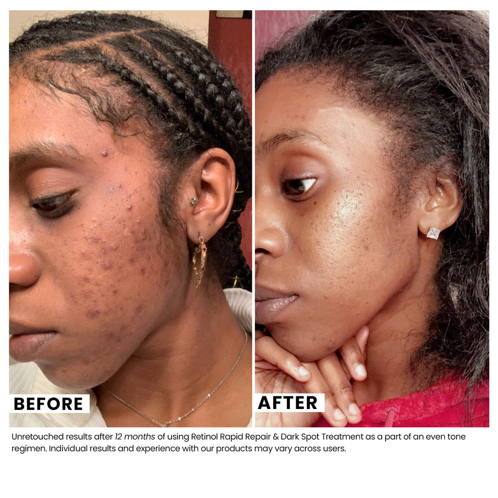 Woman's skin before and after using USRx retinol rapid repair