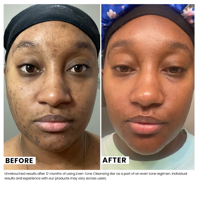 Before and after comparison of a person using an even tone cleansing bar, showing visible skin improvement.