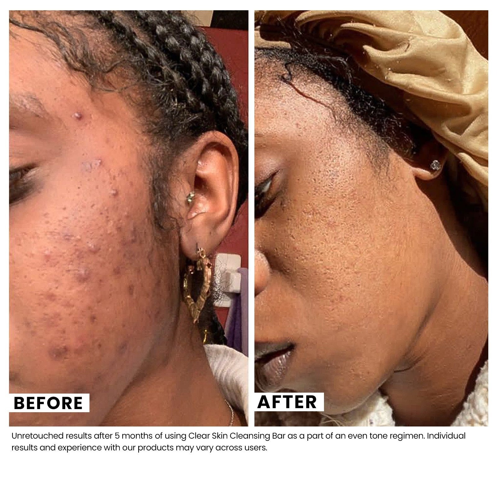 Woman's skin before and after using USRx even tone regimen