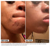 Woman's skin before and after using USRx clear skin Cleansing Bar