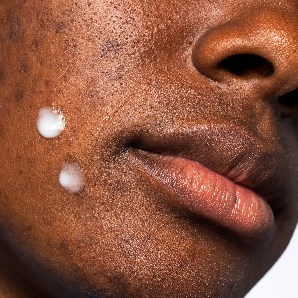 Woman with 2 small dots of USRX Clear Complexion Acne Serum + Spot Treatment on face