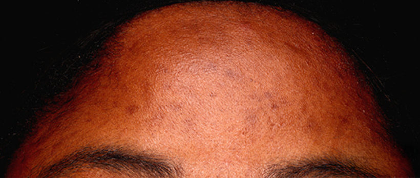 Woman's skin after using USRx HyperCorrect Intense Fading Cream