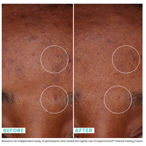Woman's skin before and after Urban Skin RX HyperCorrect Intense Fading Cream with visibly improved skin