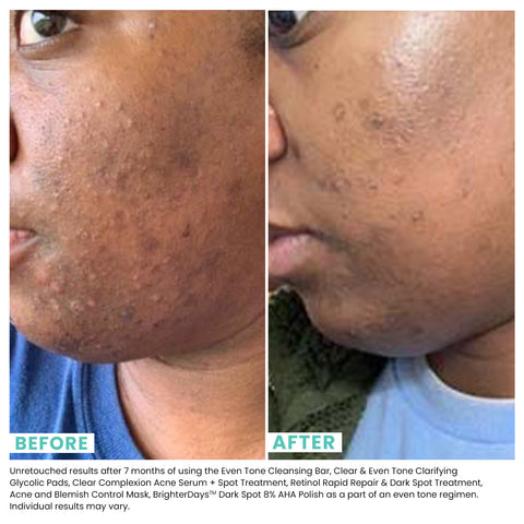 Woman's skin before and after using USRX Clear & Even Tone Clarifying Glycolic Pads