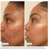 Comparison of woman's skin before and after using Jar of USRX Even Tone Cleansing Bar treatment for dark marks 