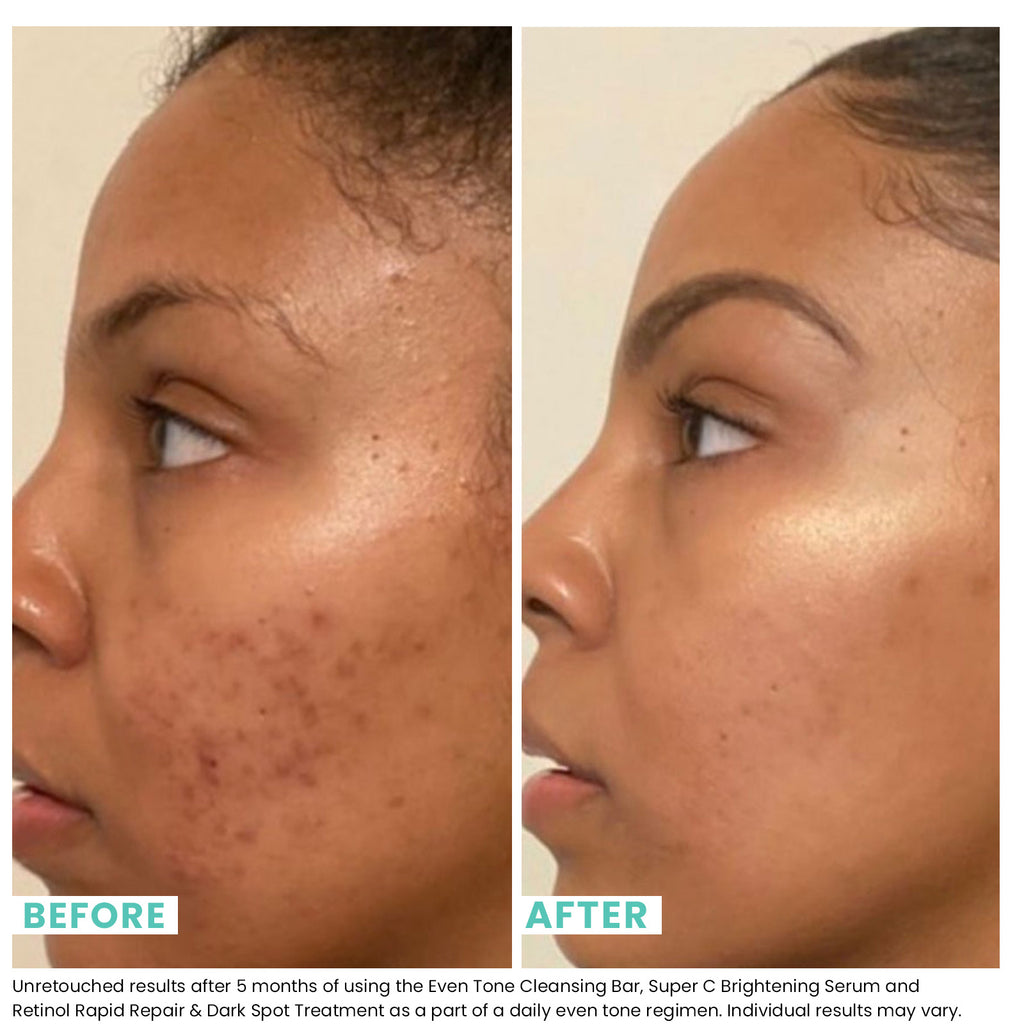 Comparison of woman's skin before and after using Jar of USRX Even Tone Cleansing Bar treatment for dark marks 