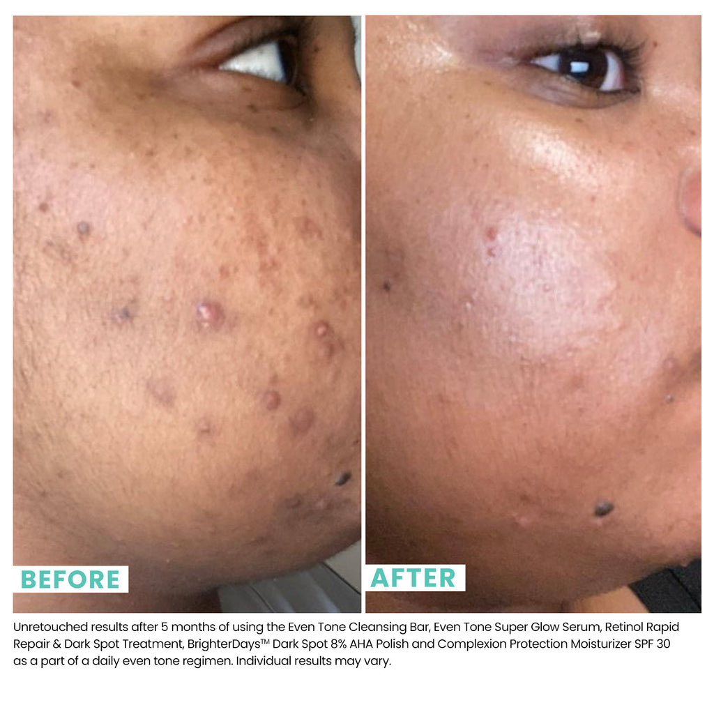 Woman's skin before and after using USRX Even Tone Super Glow Serum