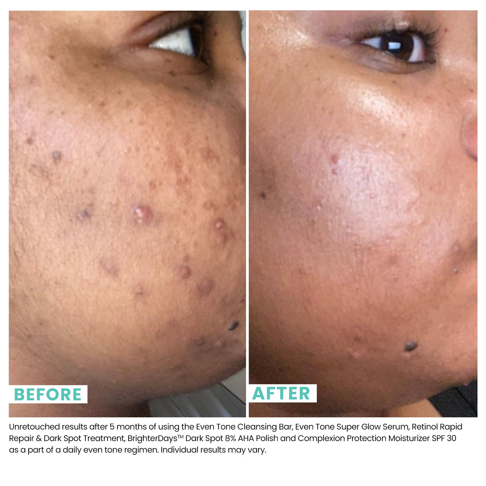 Woman's skin before and after using USRX Even Tone Super Glow Serum