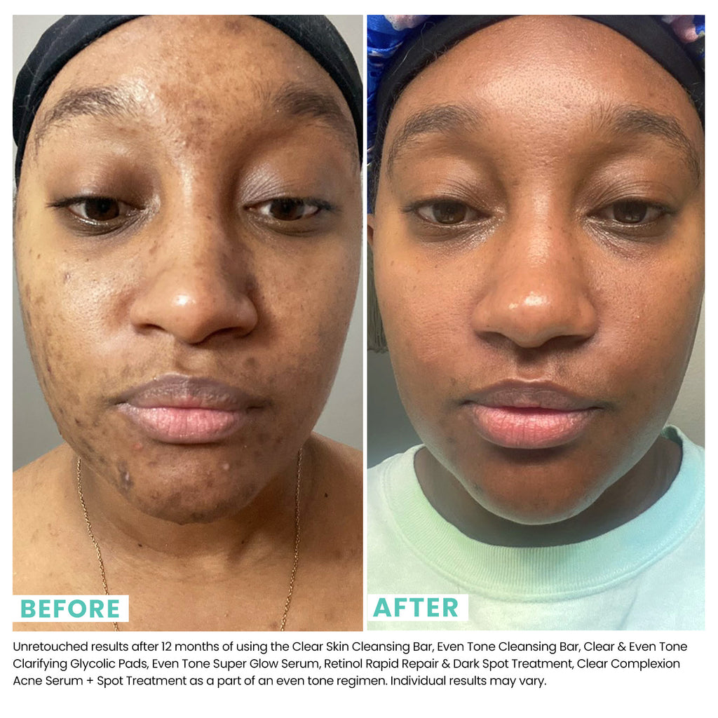 Woman's face before and after using USRX Retinol Rapid Repair & Dark Spot Treatment