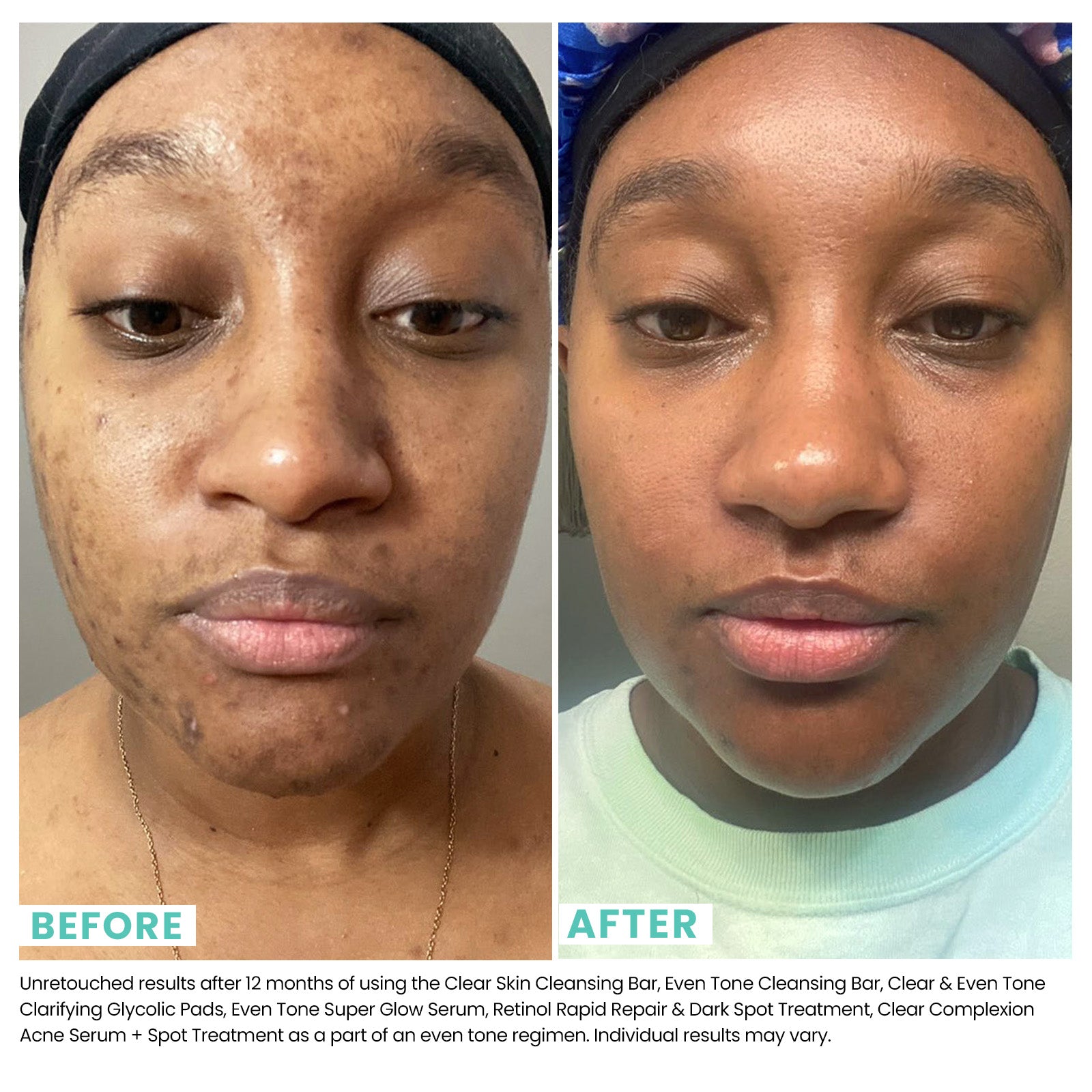 Woman's face before and after using USRX Retinol Rapid Repair & Dark Spot Treatment